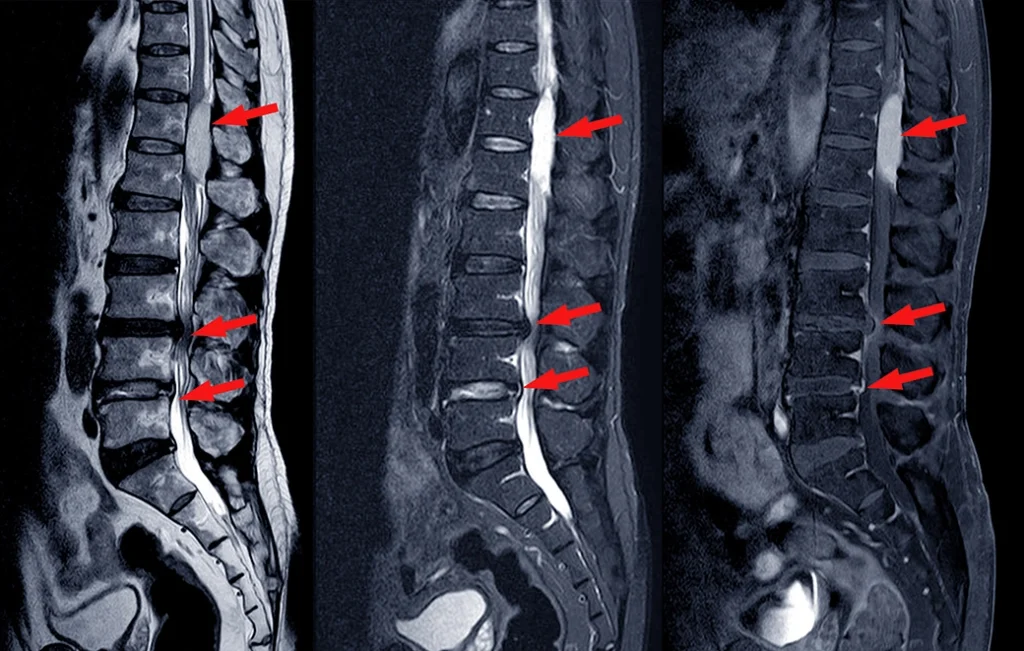 Natural Ways To Fix Spinal Stenosis - Without Surgery!