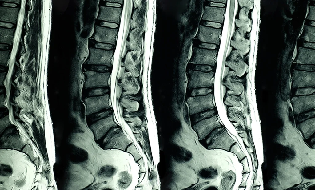 Cure Degenerative Disc Disease