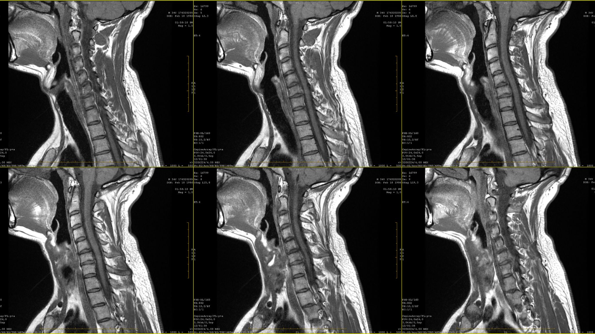 Cervical Radiculopathy