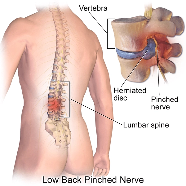 A medical depiction of the low back discs and nerves anatomy.