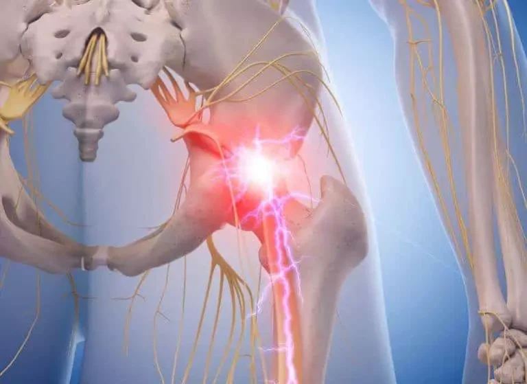 A medical anatomy image of the nerves running through a pelvis.